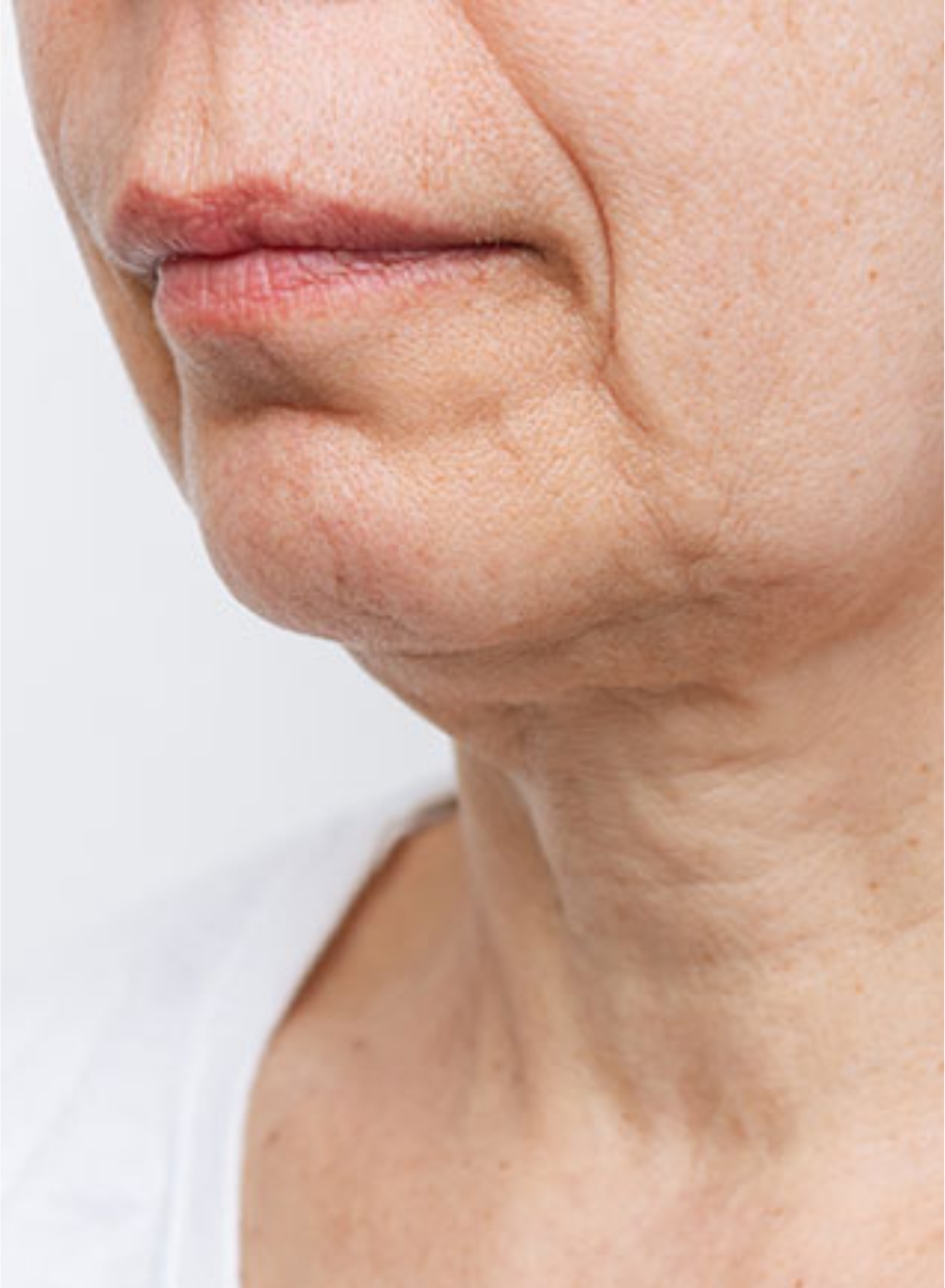 Après traitement SKINYLISS