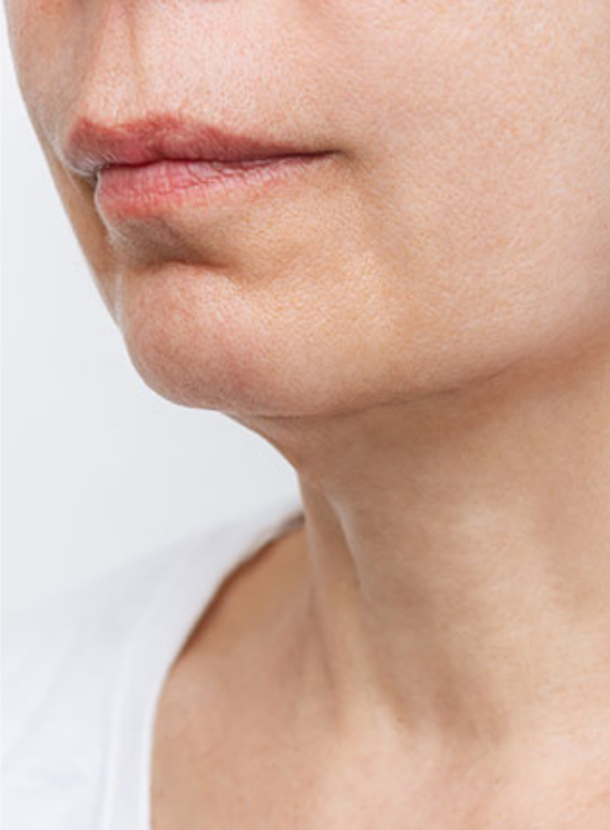 Avant traitement SKINYLISS